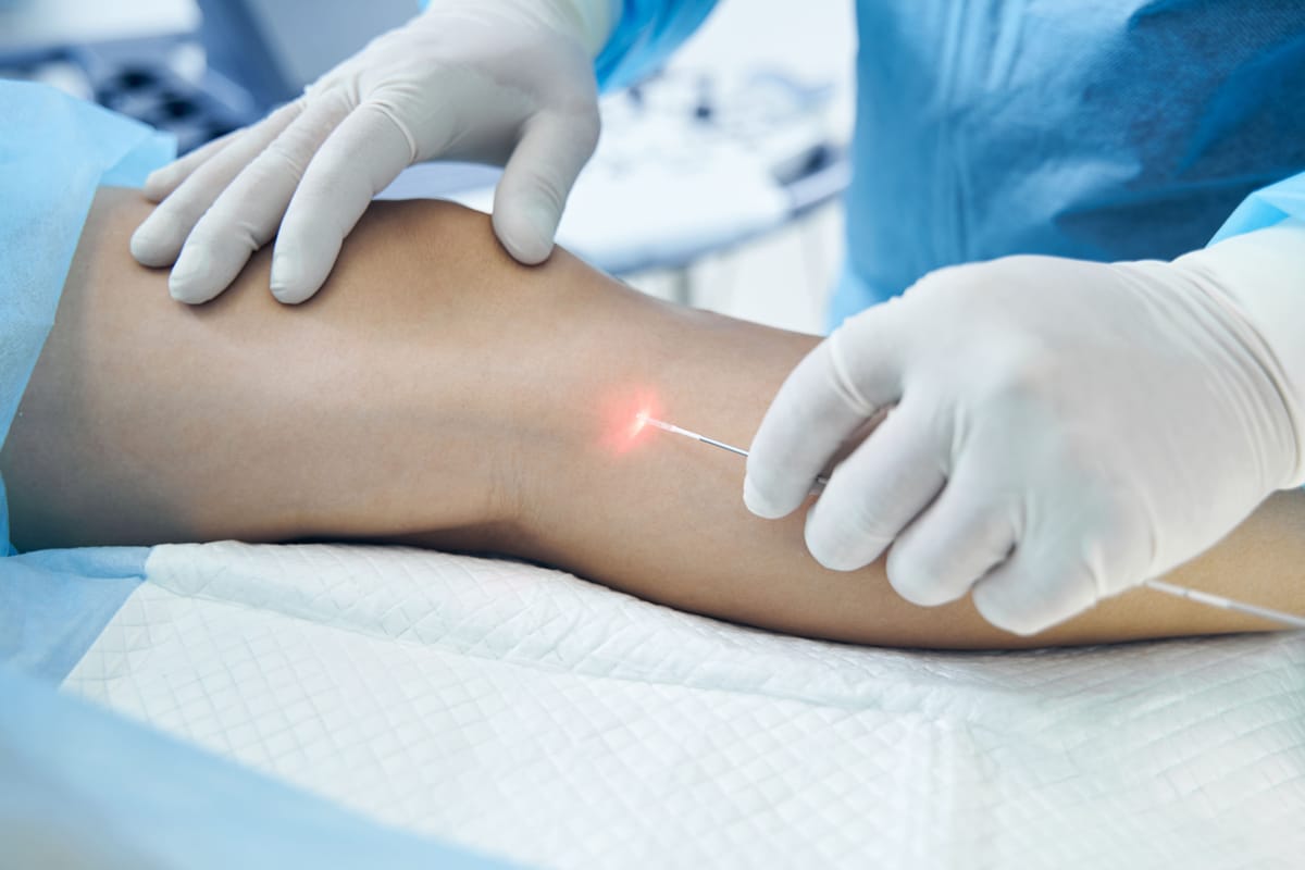 Cirurgia de Varizes por Endolaser