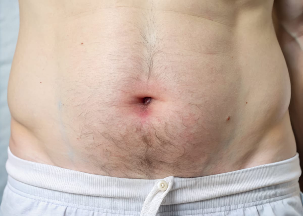 Hérnias da Parede Abdominal