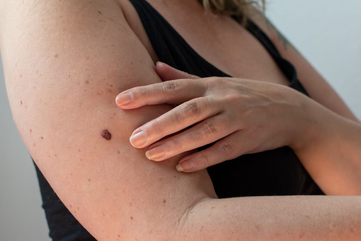 Melanoma e Outros Cânceres de Pele