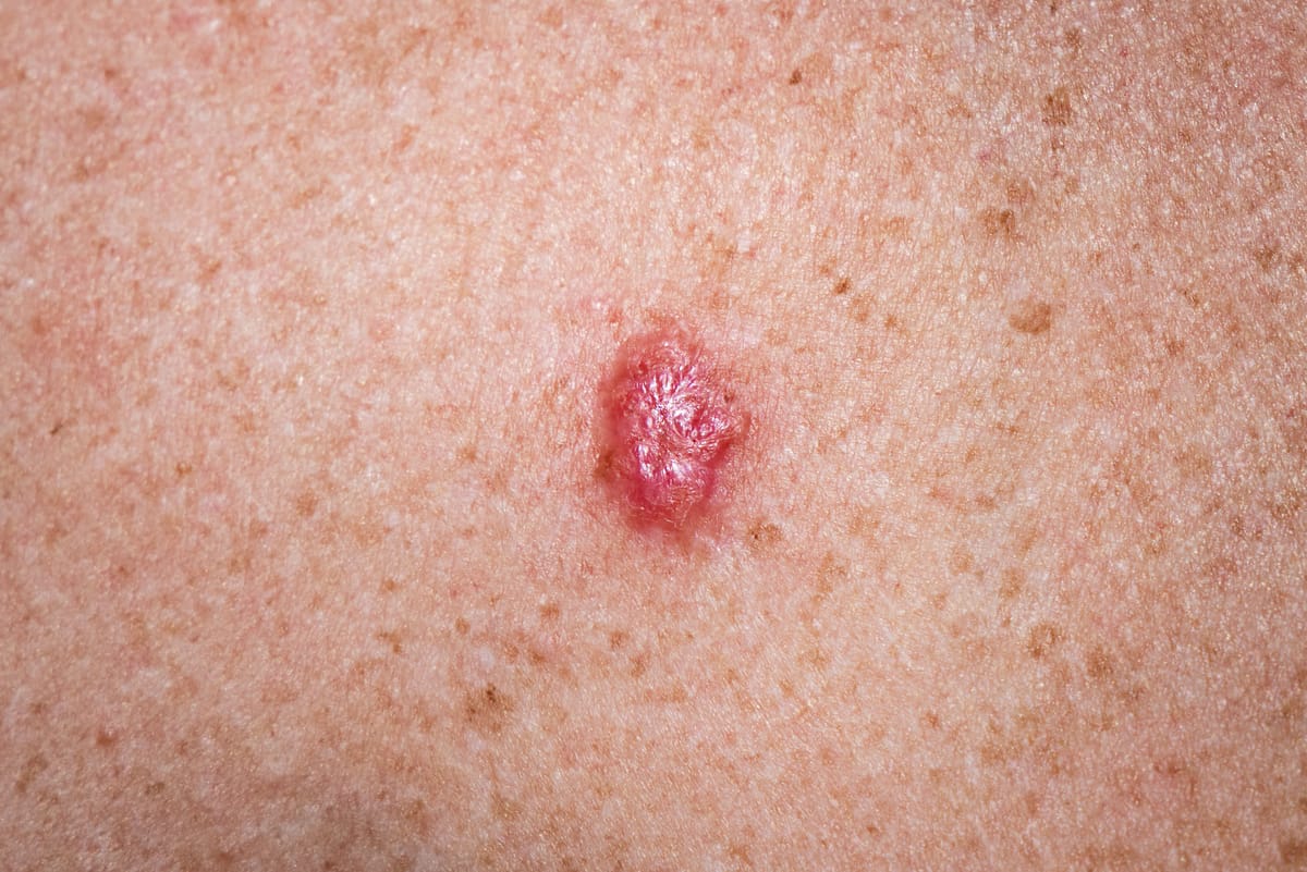 Carcinoma Basocelular
