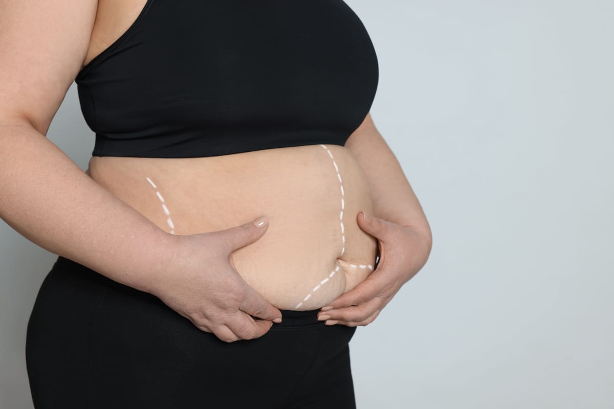 Cirurgia Bariátrica e Metabólica