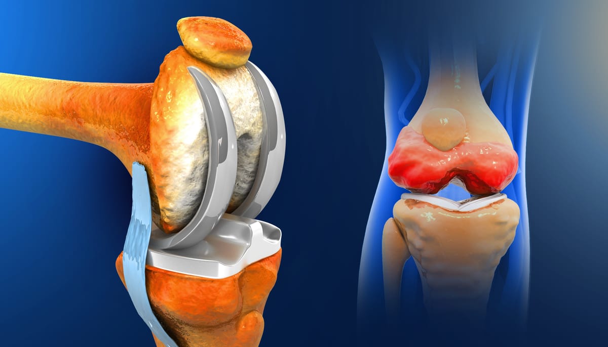 Artroplastia total de joelho