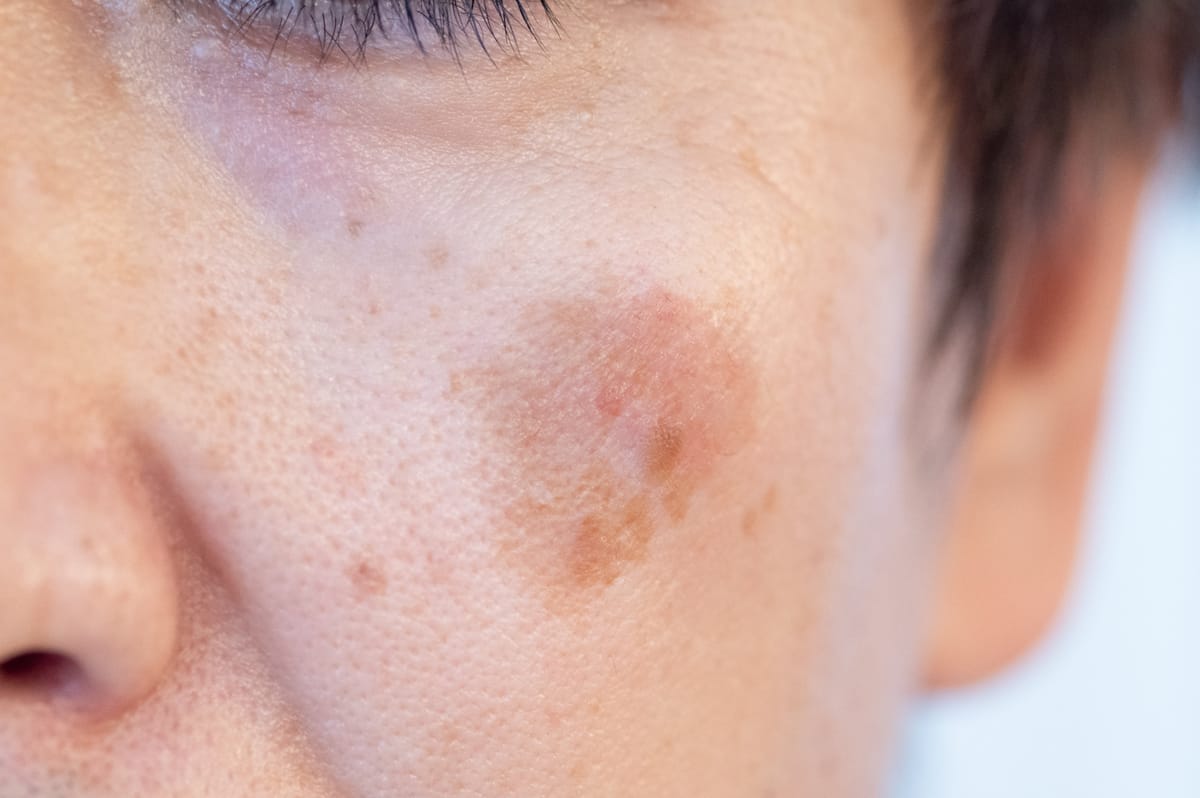 Neoplasias Cutâneas