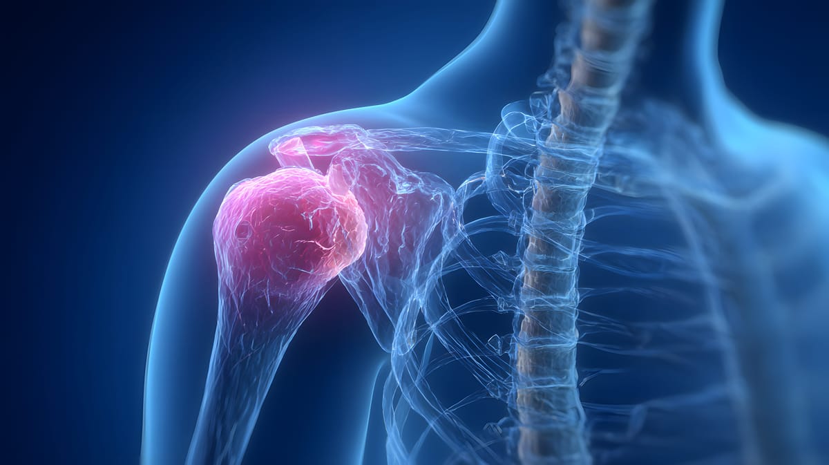 Artroplastia do Ombro (prótese)