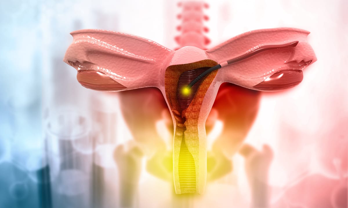 Histeroscopia