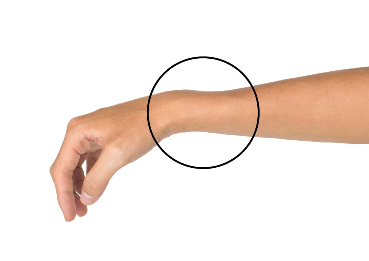 Fratura do Rádio Distal